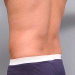 Liposuction For Men Before & After Patient #2386