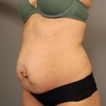 Tummy Tuck Before & After Patient #238