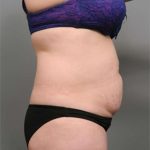 Tummy Tuck Before & After Patient #386