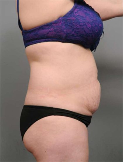 Tummy Tuck Before & After Patient #386