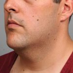 Neck Liposuction For Men Before & After Patient #2408