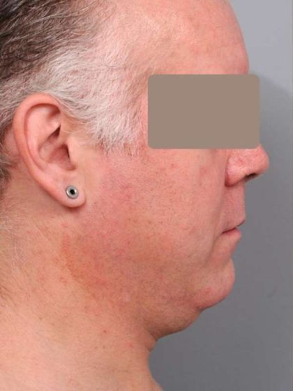 Neck Liposuction For Men Before & After Patient #2426