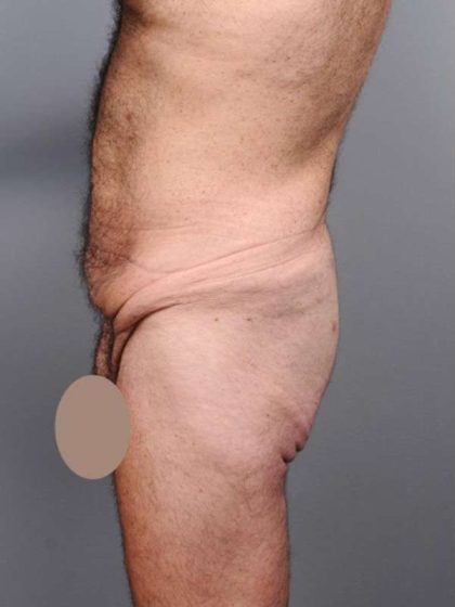 Lower Body Lift For Men Before & After Patient #2445