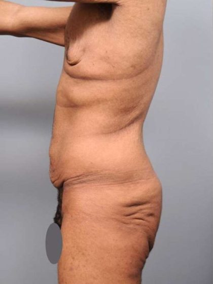 Lower Body Lift For Men Before & After Patient #2456