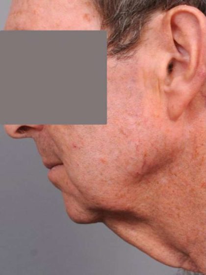 Neck Lift For Men Before & After Patient #2471