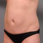 Tummy Tuck Before & After Patient #395