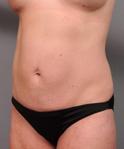 Mommy Makeover Before & After Patient #2506