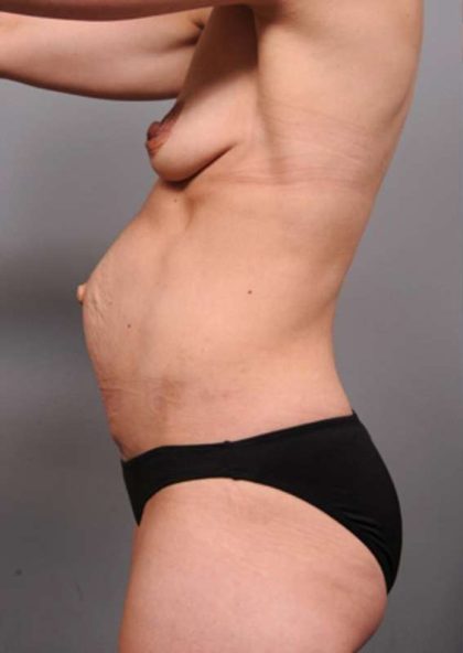 Mommy Makeover Before & After Patient #2520