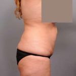 Tummy Tuck Before & After Patient #402