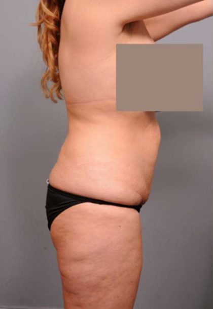 Tummy Tuck Before & After Patient #402