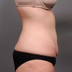 Tummy Tuck Before & After Patient #411