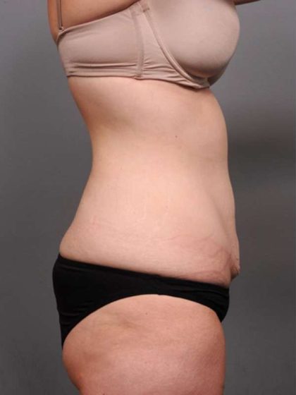 Tummy Tuck Before & After Patient #411