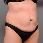 Tummy Tuck Before & After Patient #418
