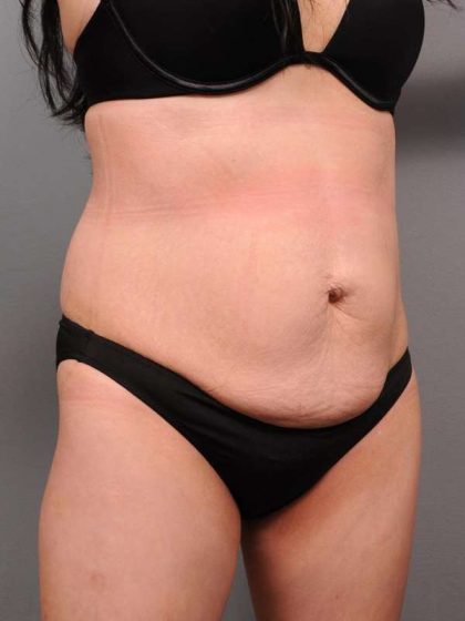 Tummy Tuck Before & After Patient #418