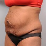 Tummy Tuck Before & After Patient #427
