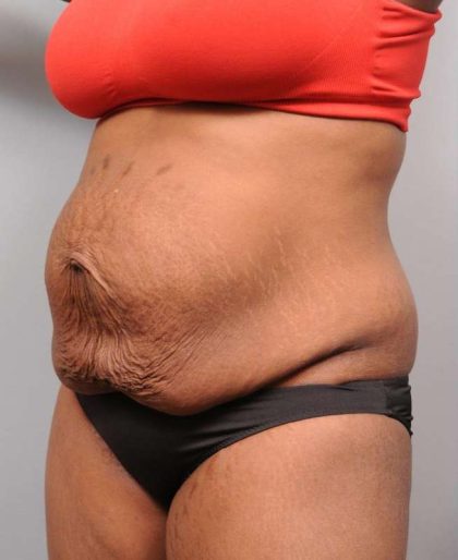 Tummy Tuck Before & After Patient #427