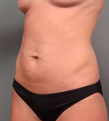 Tummy Tuck Before & After Patient #443