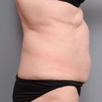 Tummy Tuck Before & After Patient #450