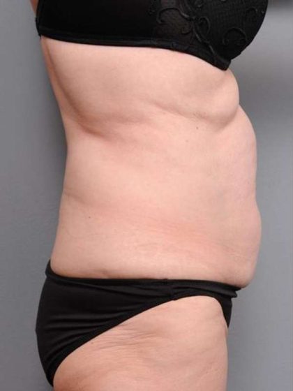 Tummy Tuck Before & After Patient #450
