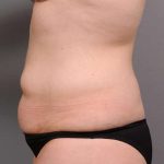 Tummy Tuck Before & After Patient #463