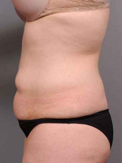 Tummy Tuck Before & After Patient #463