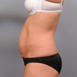 Tummy Tuck Before & After Patient #474