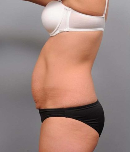 Tummy Tuck Before & After Patient #474