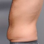 Tummy Tuck Before & After Patient #482