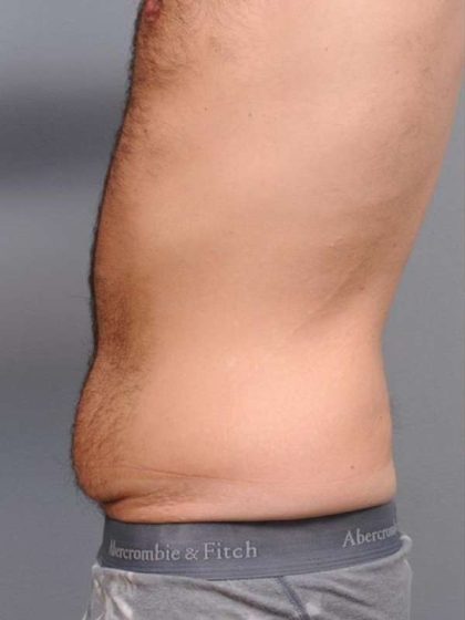 Tummy Tuck Before & After Patient #482