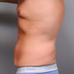 Tummy Tuck Before & After Patient #489