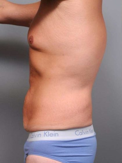 Tummy Tuck Before & After Patient #489