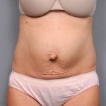 Tummy Tuck Before & After Patient #497