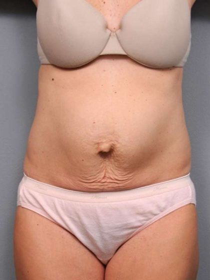 Tummy Tuck Before & After Patient #497