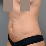 Tummy Tuck Before & After Patient #504