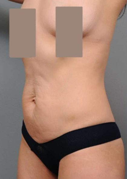 Tummy Tuck Before & After Patient #504