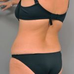 Tummy Tuck Before & After Patient #515