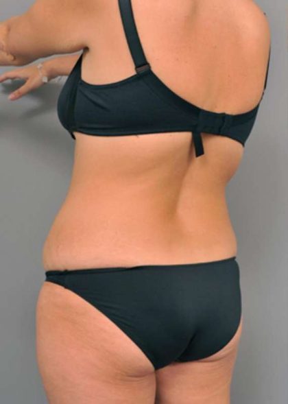 Tummy Tuck Before & After Patient #515