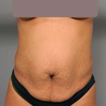 Tummy Tuck Before & After Patient #522
