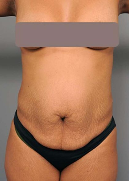 Tummy Tuck Before & After Patient #522