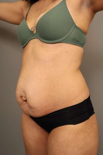 Liposuction Before & After Patient #550