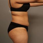 Liposuction Before & After Patient #563