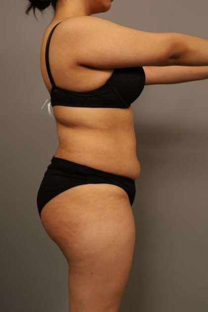 Liposuction Before & After Patient #563