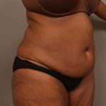 Tummy Tuck Before & After Patient #574