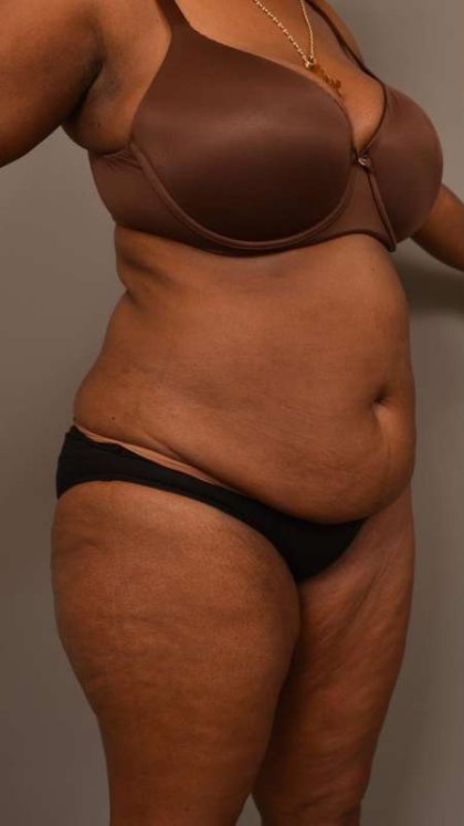 Tummy Tuck Before & After Patient #574
