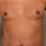 Liposuction Before & After Patient #581