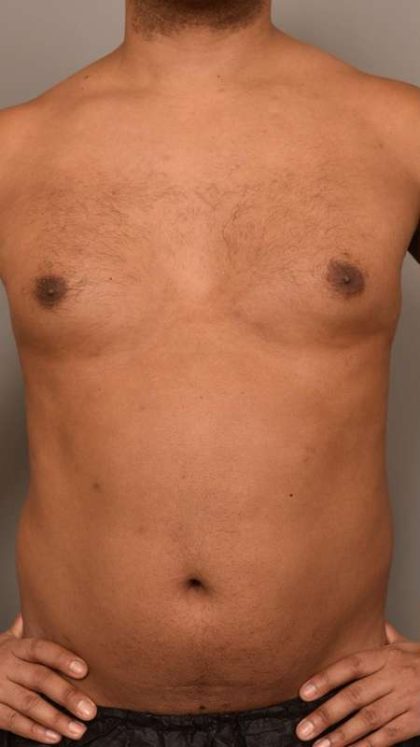 Liposuction Before & After Patient #581