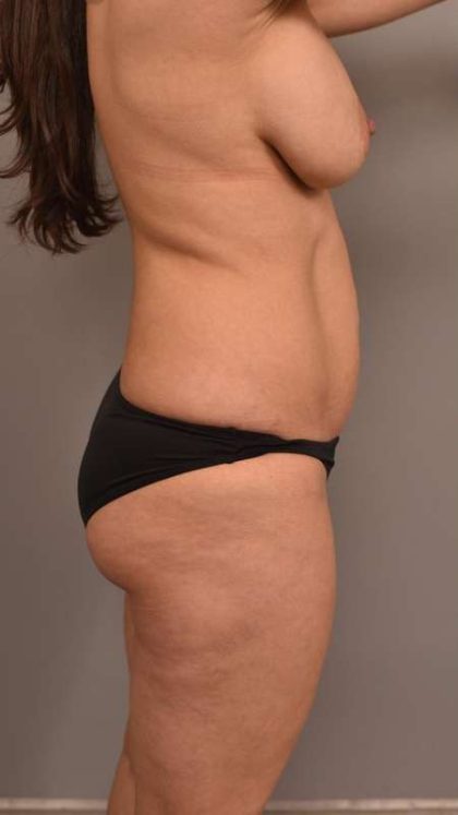Liposuction Before & After Patient #595