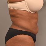 Liposuction Before & After Patient #604