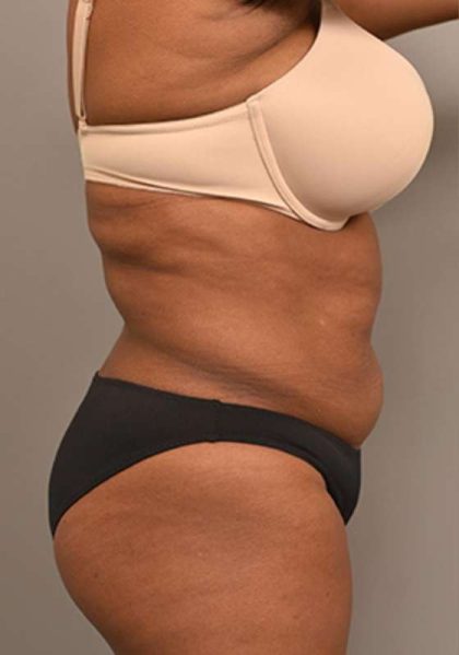 Liposuction Before & After Patient #604