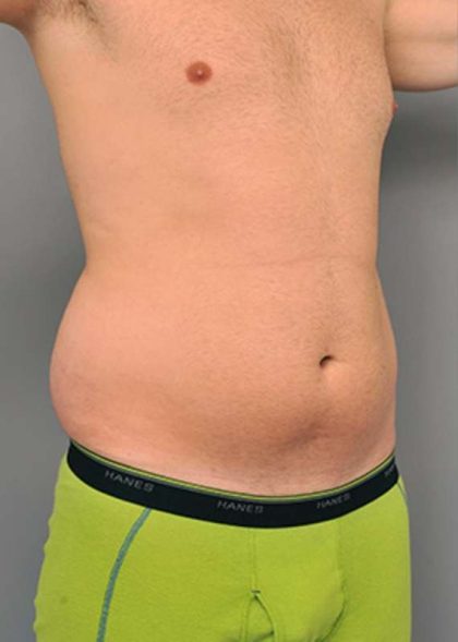 Liposuction Before & After Patient #611